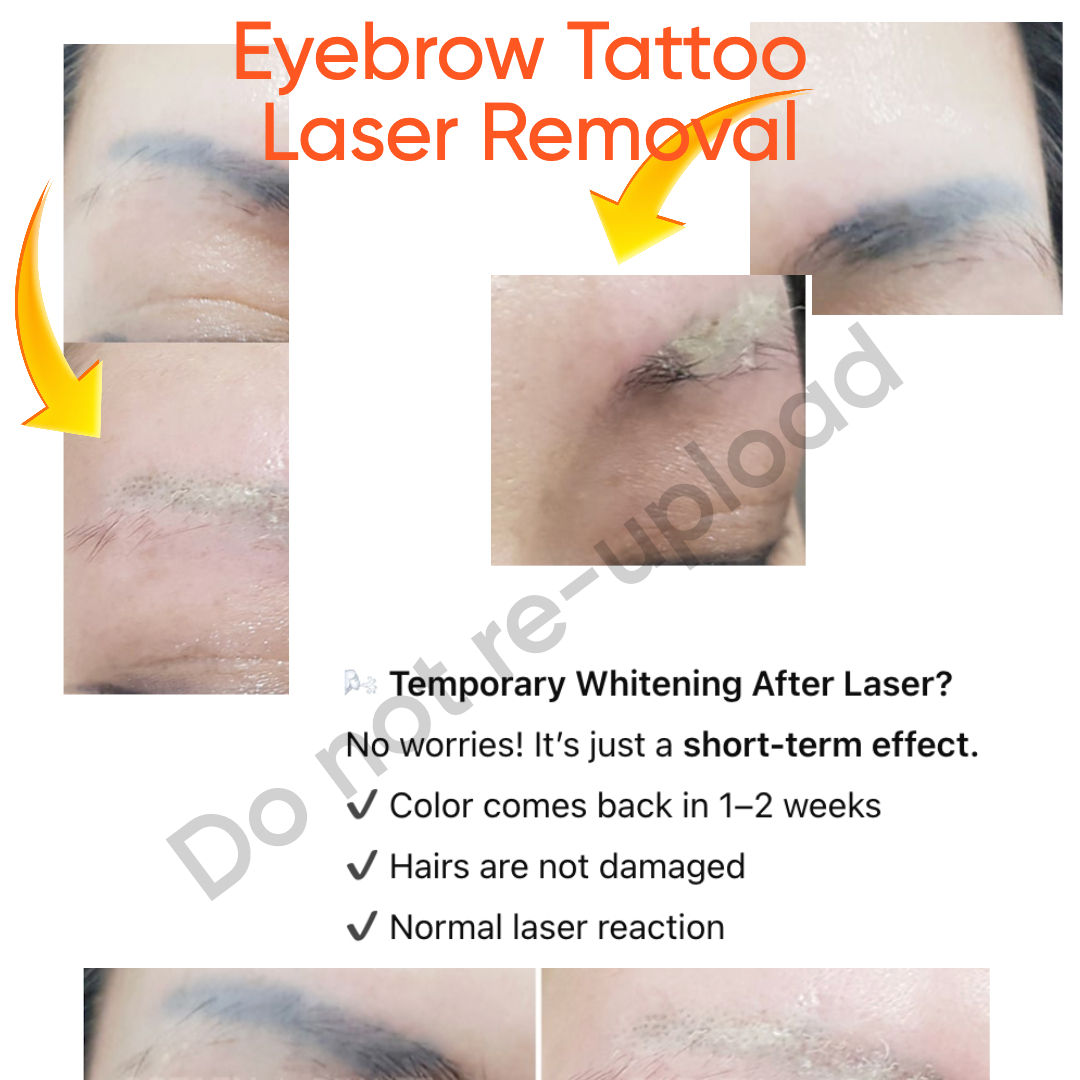 Tattoo Removal Result 2